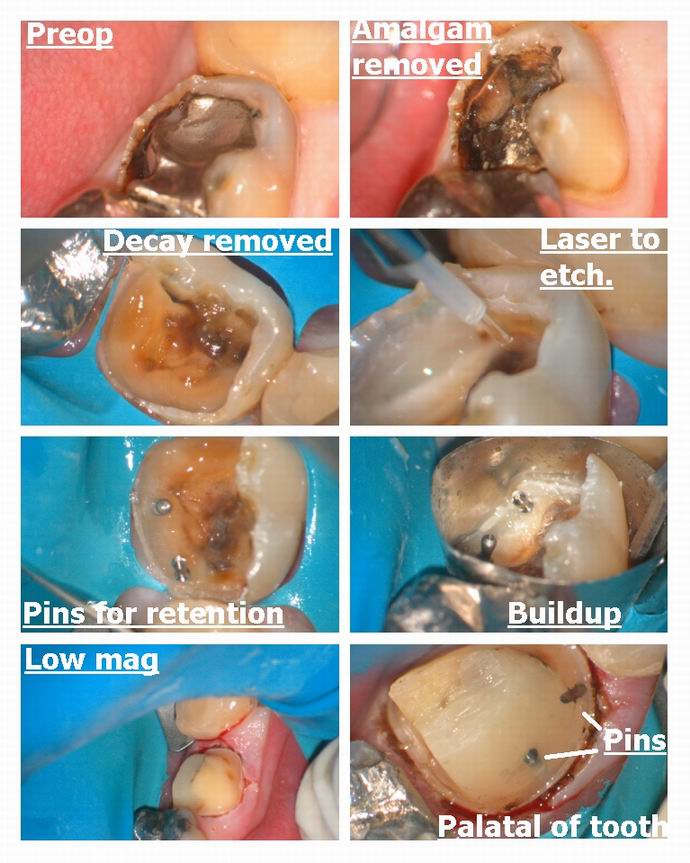 Resize of Crown on badly broken down tooth..jpg